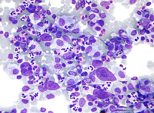 Hodgkin lymphoma